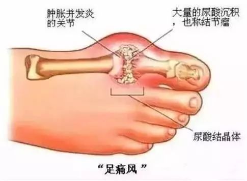 痛风的一个小方子，一点也不难喝，太棒了！-治疗痛风偏方秘方大全