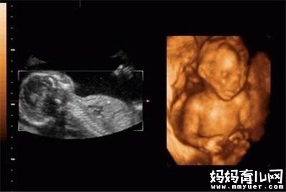 怀孕八个月胎儿彩超图 吃手指,打哈欠模样萌翻