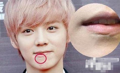 杨幂右眼伤疤疑似整容后遗症,谢娜打了多少针