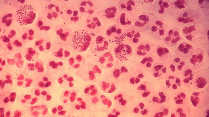 显微镜下淋菌性尿道炎,图片来源:维基百科
