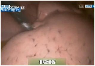肿瘤院长告诫：不想患肺癌，出现这5个变化赶紧戒烟！