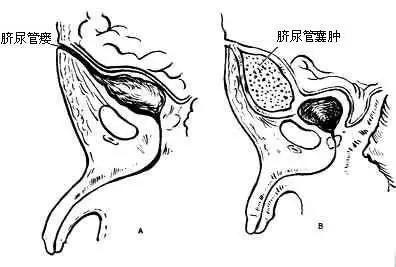 杭州12岁男孩肚脐眼突然冒水了，一查竟是尿液