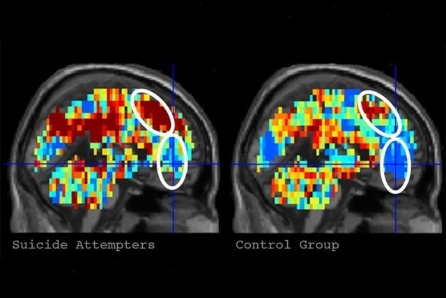 科学家通过脑部扫描算法可识别有自杀念头的人