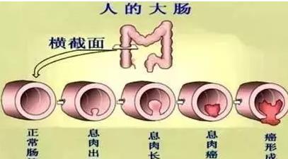 有肠息肉是否能投保 肠息肉保险公司拒保