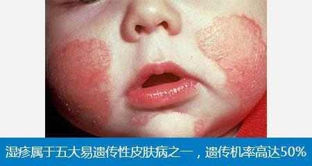 湿疹千万不要在滥用抗生素药膏了,小心皮肤产