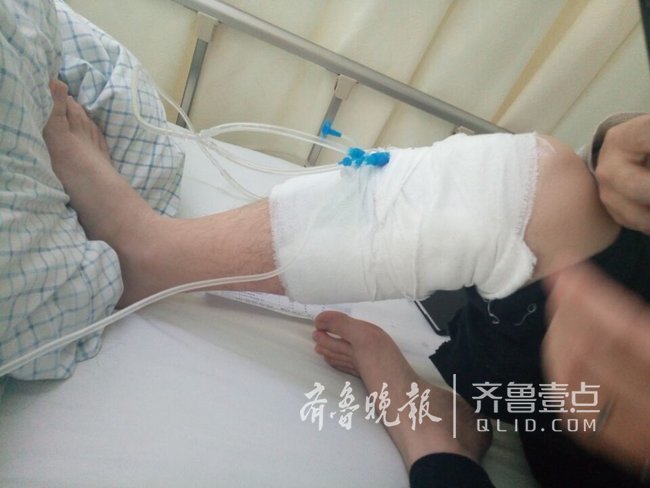 济南一小伙擦车时意外被氢氟酸灼伤,造成三级烧伤