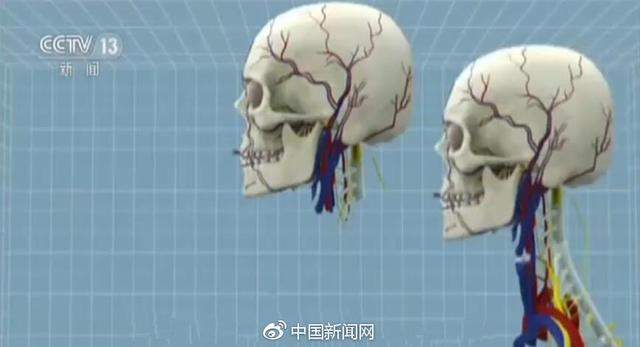 解析"换头术"背后五大疑问:活体能换么?换完还是你么?_凤凰资讯