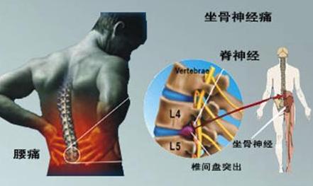 腰5骶1椎间盘突出后,骶1神经根受累麻痹而出现小腿三头肌瘫痪.