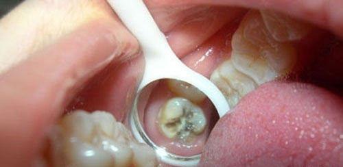 牙齿快烂了真的要拔掉吗?