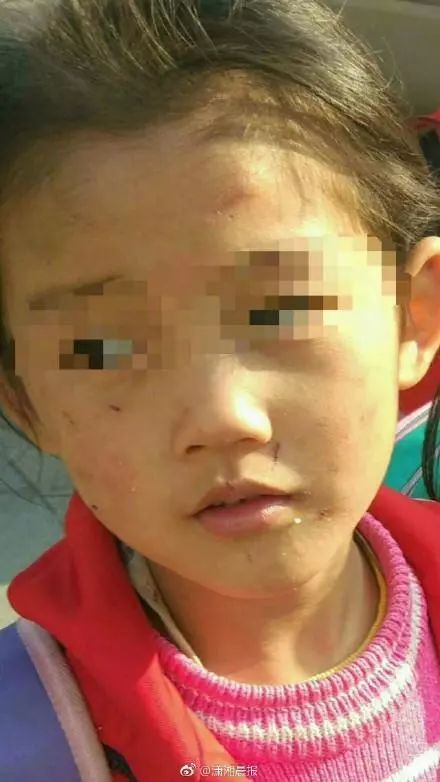 6岁女童疑被亲妈虐打 出差父亲表示“很无奈”