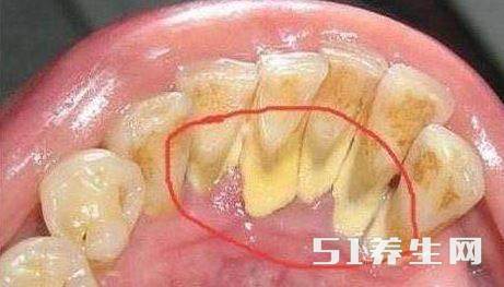 没想到用这土方法刷牙，30年的黄牙口臭全部都去光光了，仿佛重生了