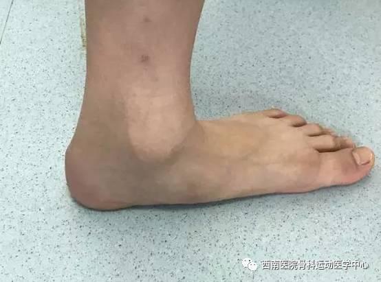 成语平足什么_平足是什么样子图片