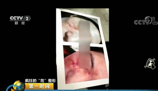 央视曝光微整形乱象:“医生”用鸡腿练手 3天上岗