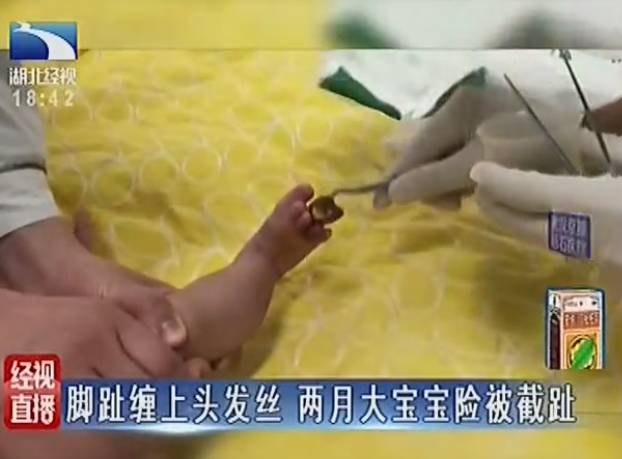 2个月宝宝脚趾发黑溃烂险截趾 罪魁祸首是根头发