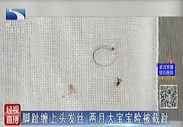 2个月宝宝脚趾发黑溃烂险截趾 罪魁祸首是根头发