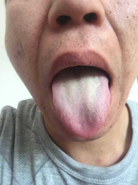 珍贵舌诊:脾胃湿热、脾肾阳虚、脾虚湿盛的舌