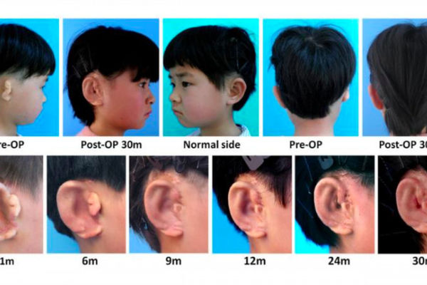 科学家利用3D打印技术为先天性耳朵畸形儿童培育新耳朵