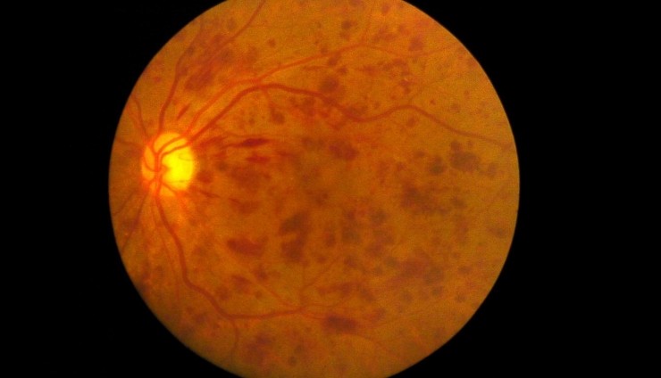 DeepMind 开发了一款眼底 AI，可同时诊断三种常见眼底疾病