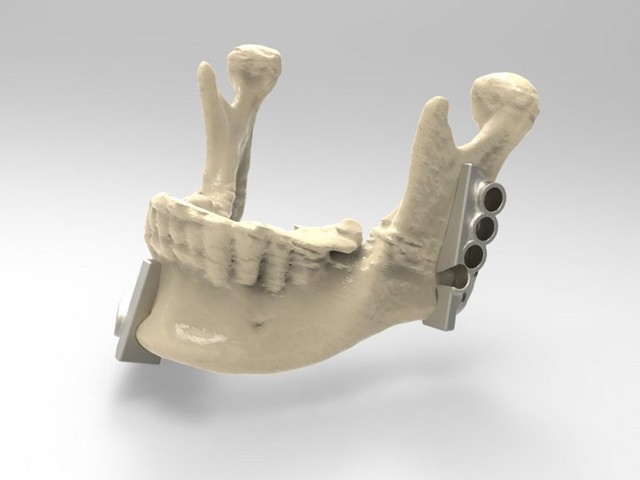 雷尼绍金属3D打印 重建下颌骨辅助面部修复手术