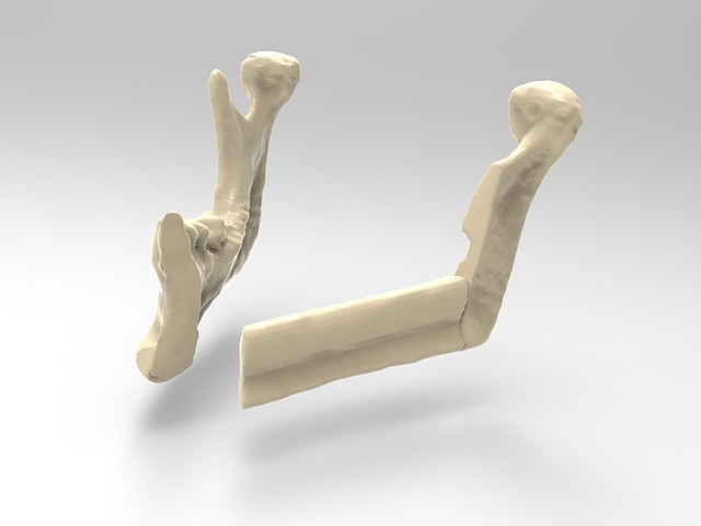 雷尼绍金属3D打印 重建下颌骨辅助面部修复手术