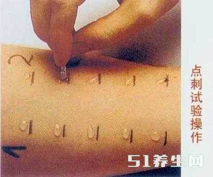 过敏原检测真能找到过敏性疾病的元凶吗?