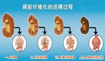 肾衰竭最青睐的四类人,想远离尿毒症,要做到