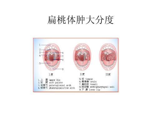 医生教你应对扁桃体和腺样体