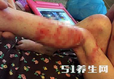 现实版的木乃伊!3岁女童抚摸都会有生命危险_图7 现实版的木乃伊!3岁女童抚摸都会有生命危险_图7