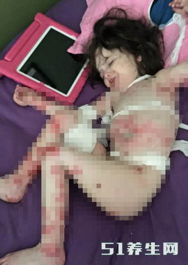 现实版的木乃伊!3岁女童抚摸都会有生命危险_图1 现实版的木乃伊!3岁女童抚摸都会有生命危险_图1