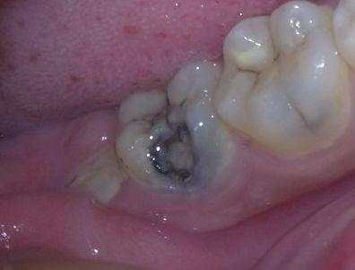 牙齿烂神经痛不痛_小孩牙齿烂个洞怎么办_牙齿烂个洞