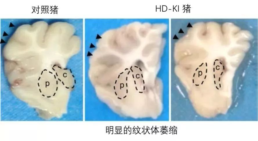 “二师兄”立新功！世界首例亨廷顿舞蹈病基因