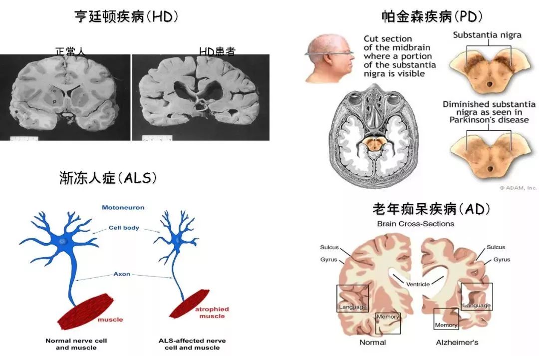 “二师兄”立新功！世界首例亨廷顿舞蹈病基因