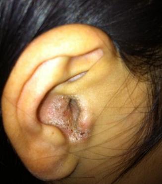 局限性外耳道炎即耳道里面长疖子