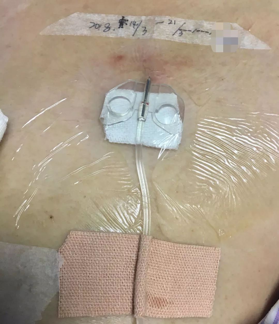 输液港扎针最全示范再也不怕病人说技术不到位了