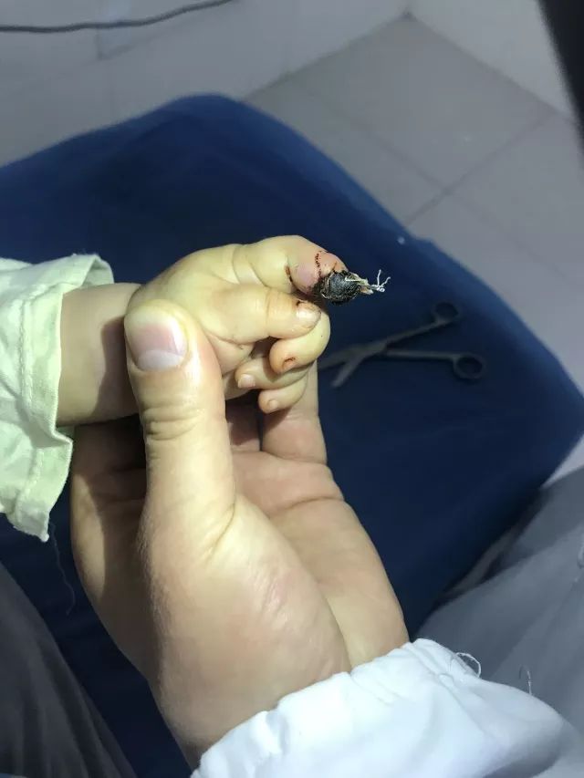 银川8个月大女婴乘飞机,手指被意外夹