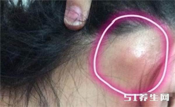 耳朵后面长了个疙瘩是怎么回事?医生说:要小心