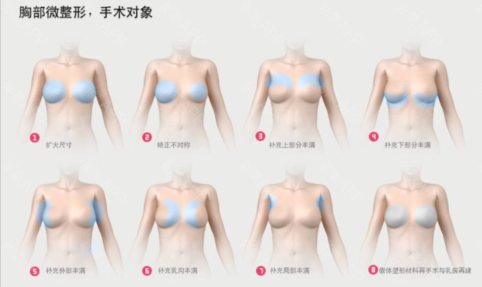 3,先天性双侧乳房不对称.