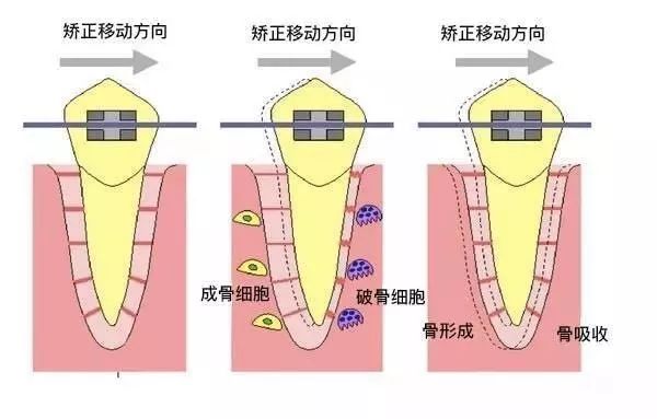 牙齿在牙槽骨里踽踽前行 想看牙齿矫正动画图, 向��