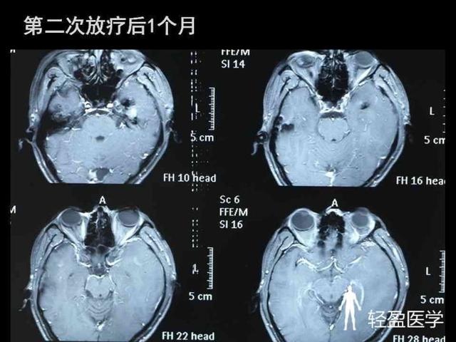 你离鼻咽癌还有多远?来了解下鼻咽癌吧!经典案例