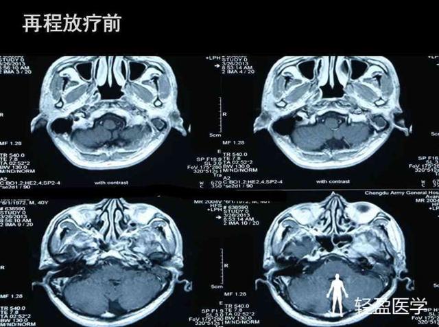 你离鼻咽癌还有多远?来了解下鼻咽癌吧!经典案例
