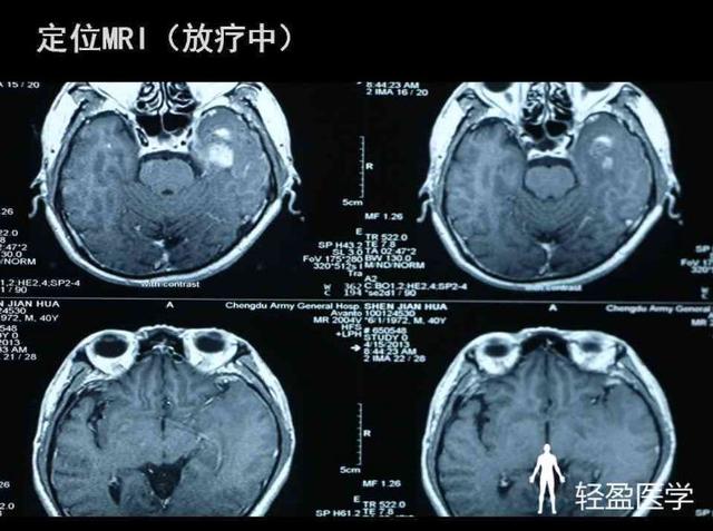 你离鼻咽癌还有多远?来了解下鼻咽癌吧!经典案例