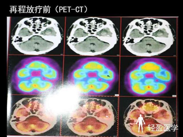 你离鼻咽癌还有多远?来了解下鼻咽癌吧!经典案例