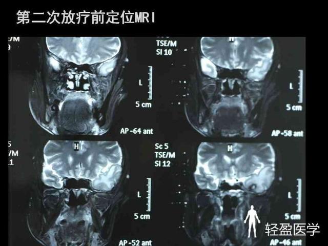 你离鼻咽癌还有多远?来了解下鼻咽癌吧!经典案例