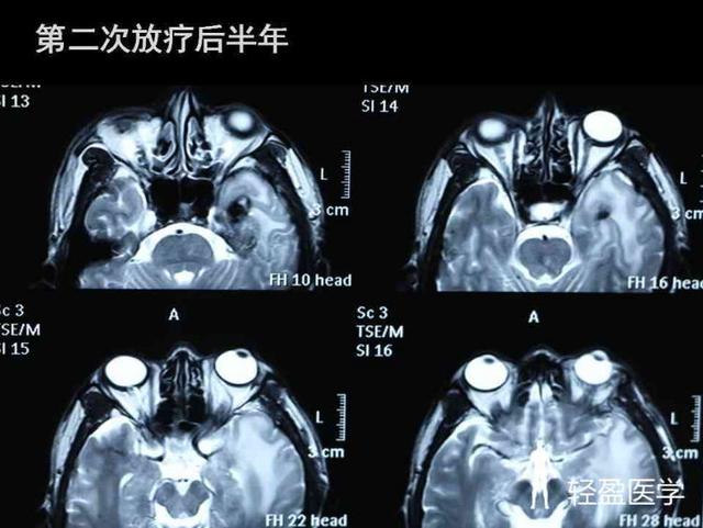 你离鼻咽癌还有多远?来了解下鼻咽癌吧!经典案例