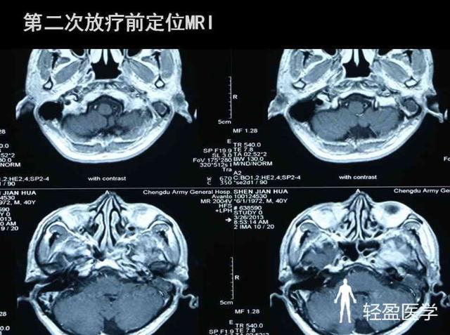 你离鼻咽癌还有多远?来了解下鼻咽癌吧!经典案例