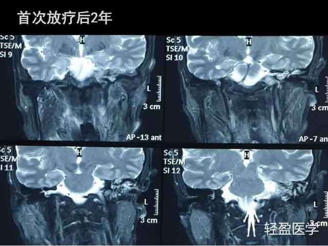 你离鼻咽癌还有多远?来了解下鼻咽癌吧!经典案例