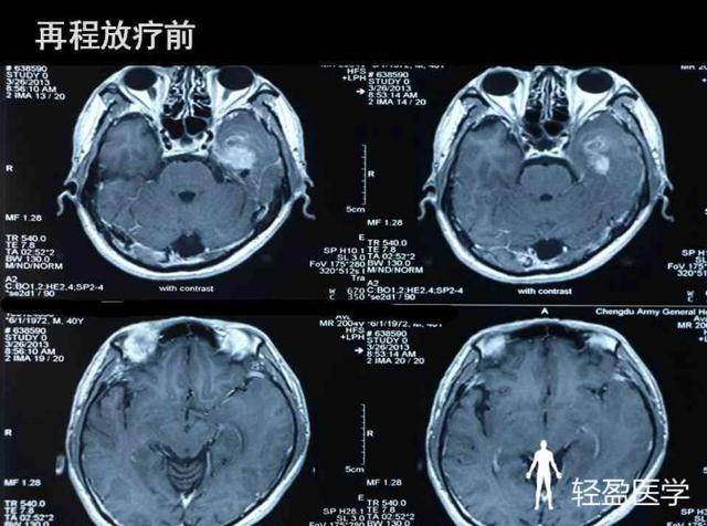 你离鼻咽癌还有多远?来了解下鼻咽癌吧!经典案例