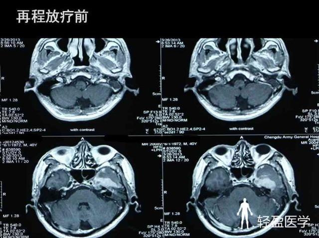 你离鼻咽癌还有多远?来了解下鼻咽癌吧!经典案例