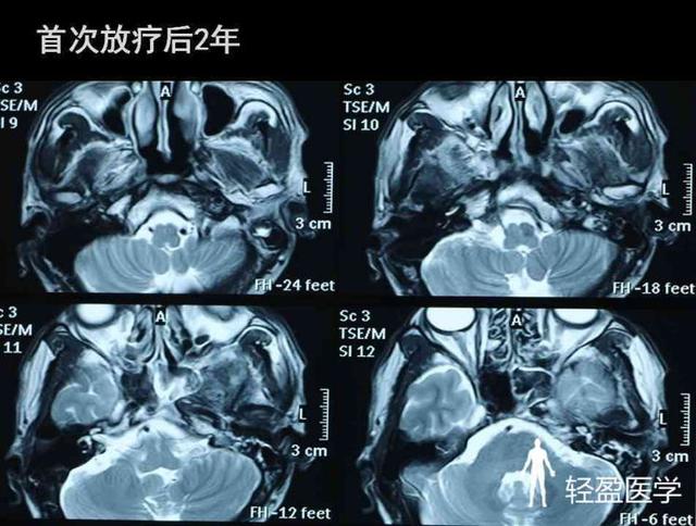 你离鼻咽癌还有多远?来了解下鼻咽癌吧!经典案例