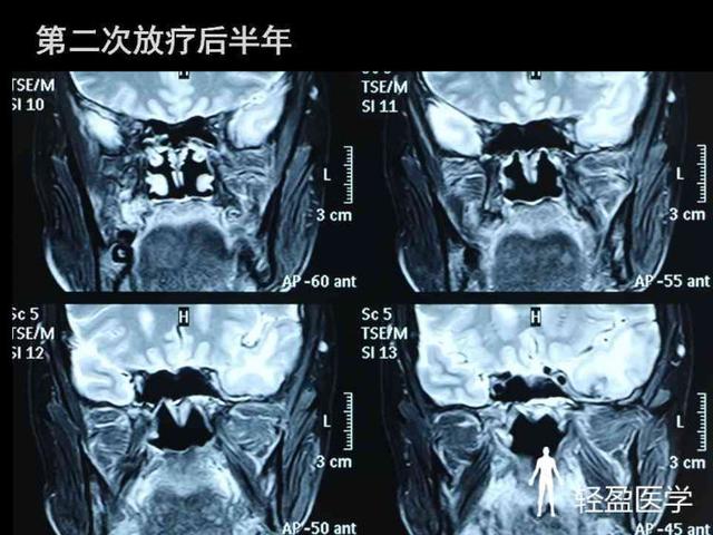 你离鼻咽癌还有多远?来了解下鼻咽癌吧!经典案例